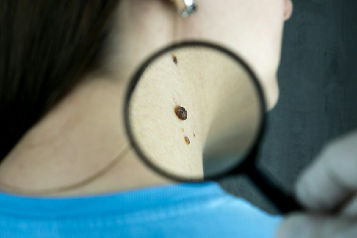 Dermatologue examinant un grain de beauté, illustration de la règle ABCDE